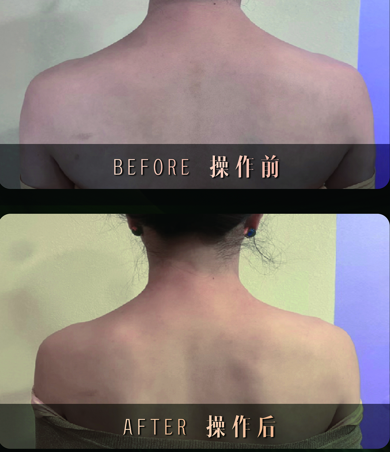 轻雕美体针成功案例