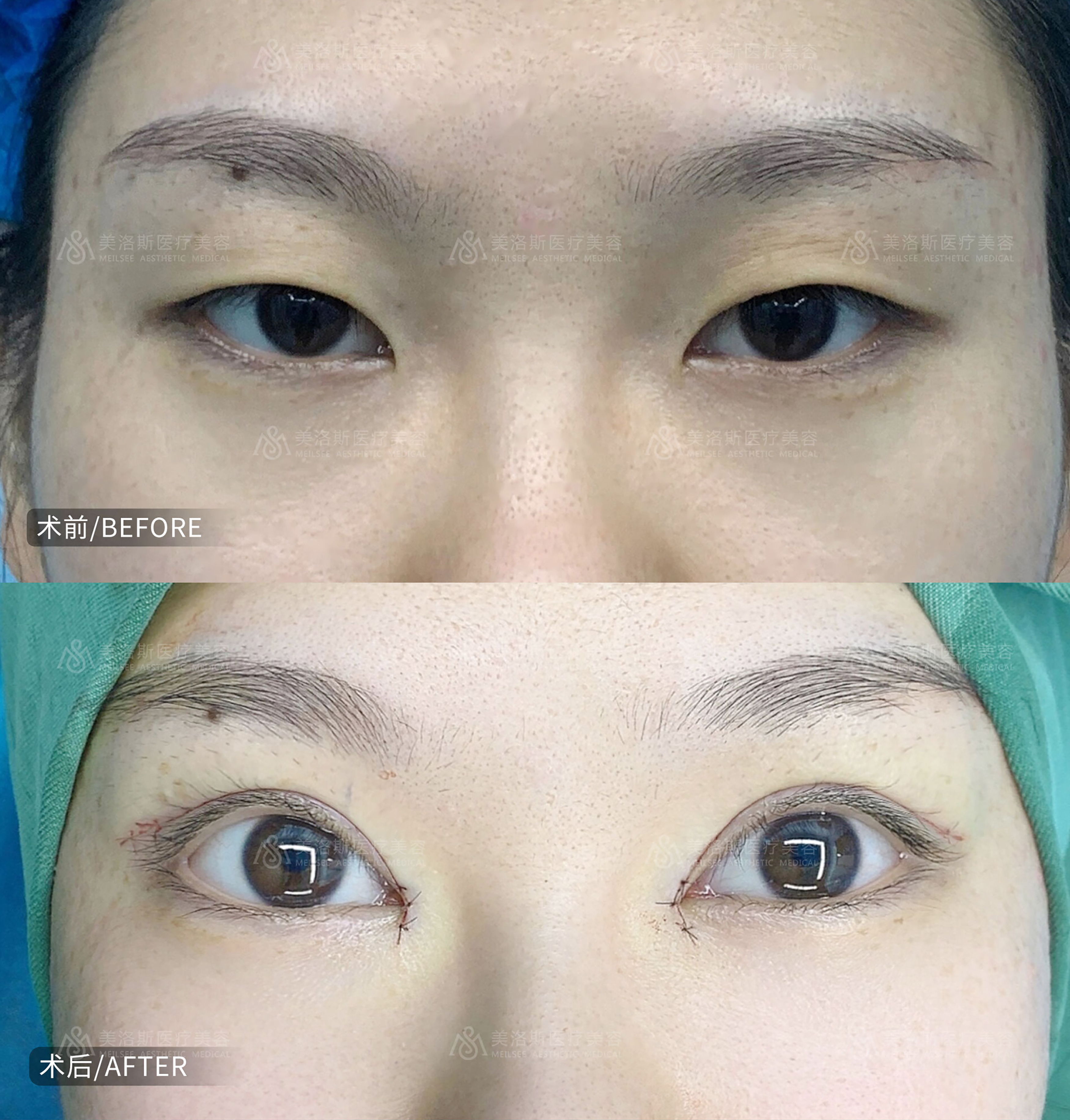 动感眉眼术成功案例