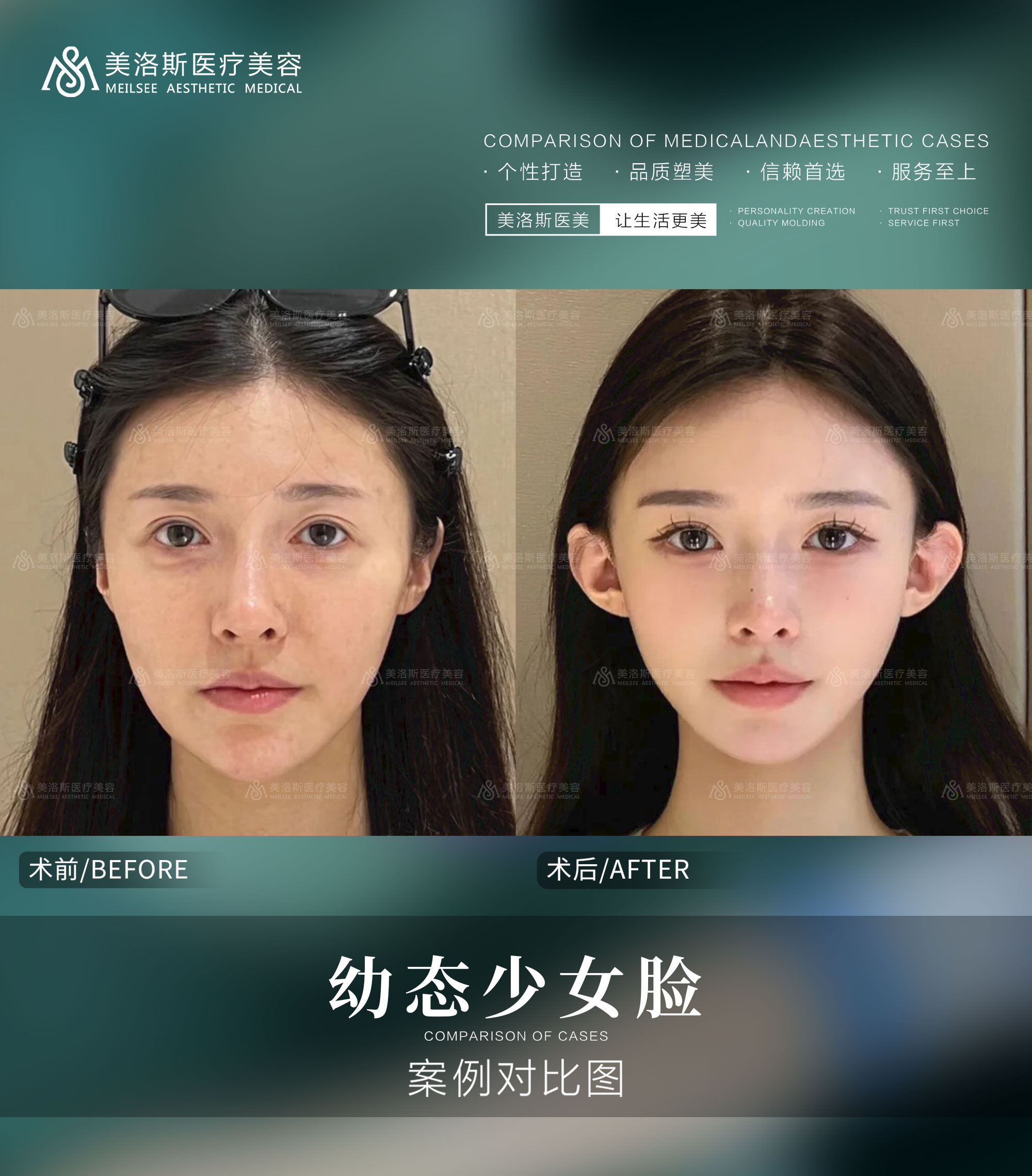 幼态少女脸成功案例