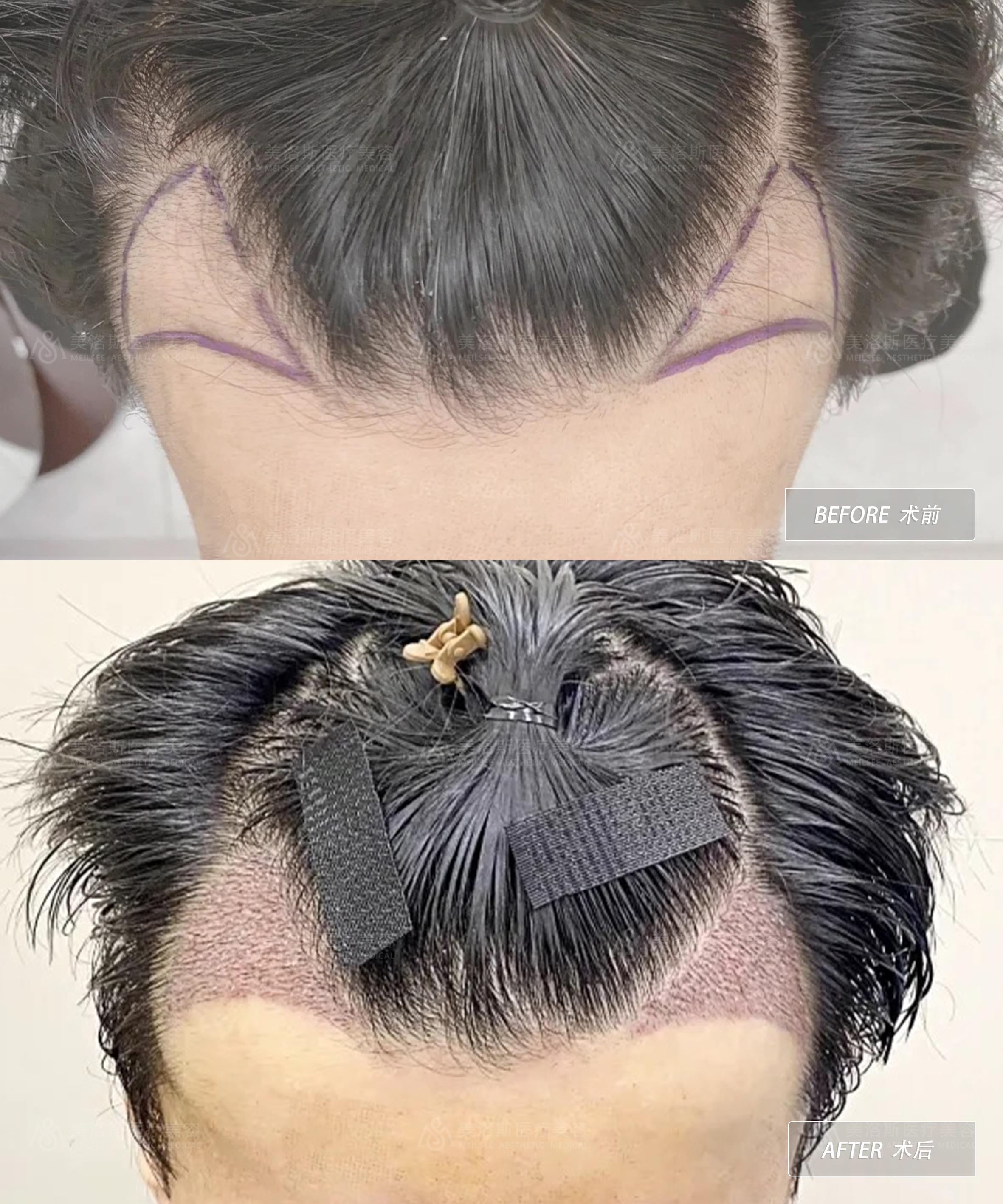 精密植发术成功案例